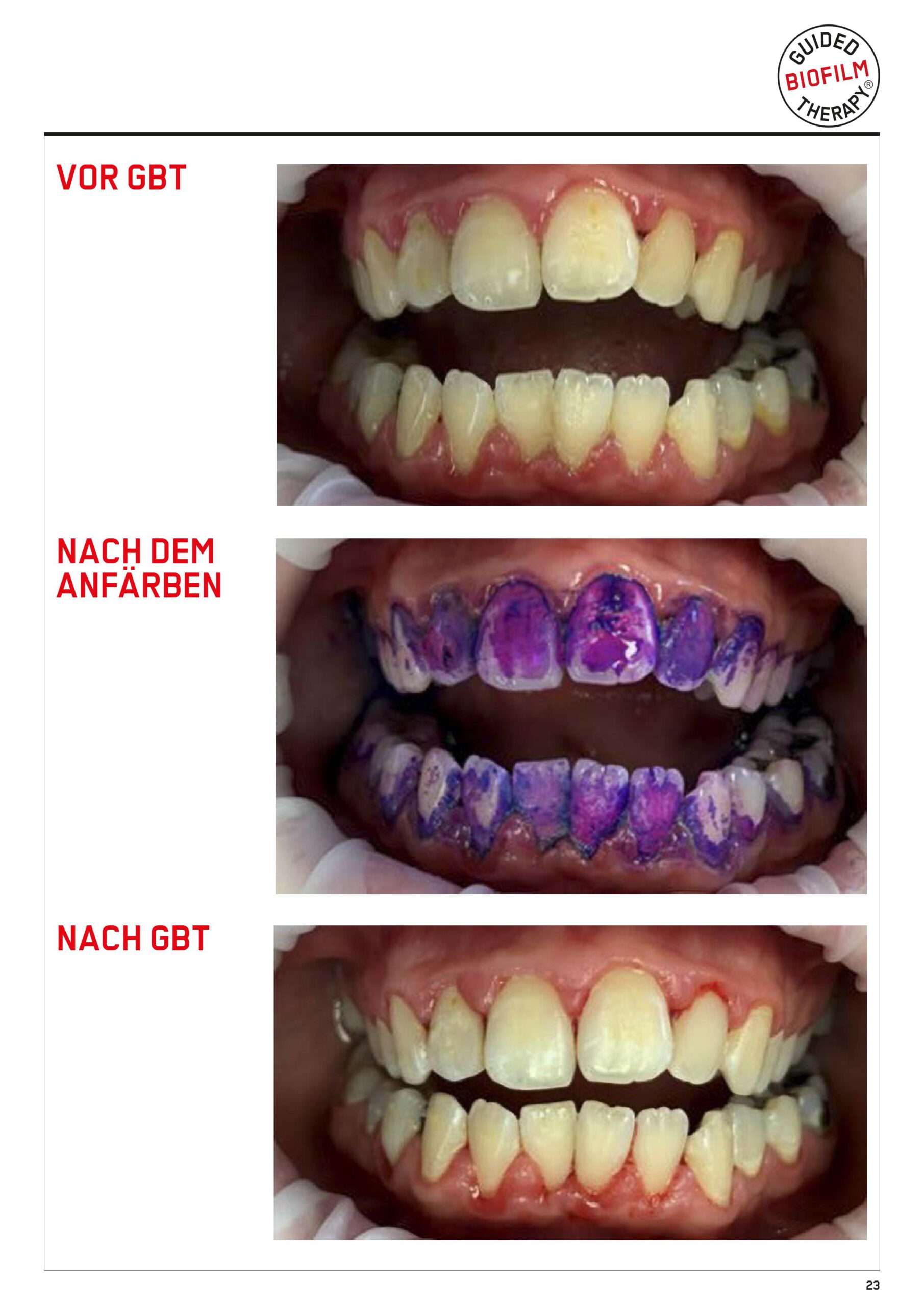 guided Biofilm Therapy, professionelle Zahnreinigung